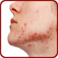 Acne Causes, & Treatments on 9Apps