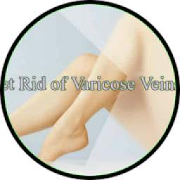 varicose veins