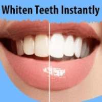 How to Whiten Teeth Instantly