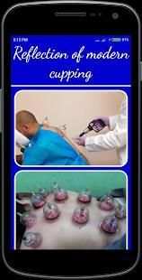 Cupping Therapy screenshot 1
