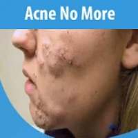 Acne No More on 9Apps