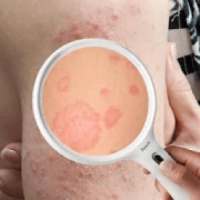 Skin Diseases Expert Hindi