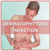 Dermatophytosis Infection