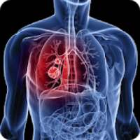 Non Small Cell Lung Cancer Treatment on 9Apps