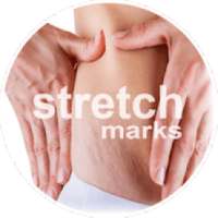 Stretch Marks - How to get rid of stretch marks on 9Apps