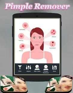 Acne Remover Photo Editor - Pimple remover screenshot 1