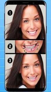 Braces Photo Editor -My Fake Look & Brace Yourself screenshot 4