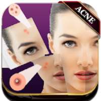 Acne Remover Photo Editor - Pimple remover on 9Apps