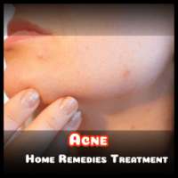 Cure Acne - Home Remedies Treatment