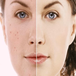 ikon Pimples Removing Tips