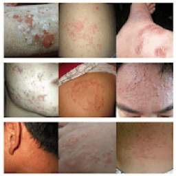 All Skin Infections & Treatments