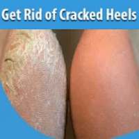 Get Rid of Cracked Heels