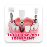 Tooth Implant Treatment on 9Apps