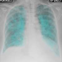 Chest X-Ray And Pathology