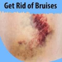 Get Rid of Bruises