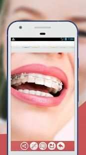 Braces Teeth Photo Editor screenshot 3
