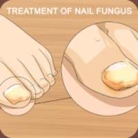 Nail fungus: treatment and prevention on 9Apps