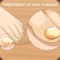 Nail fungus: treatment and prevention