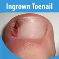 Ingrown Toenail on 9Apps