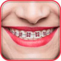 Braces Photo on 9Apps