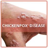 Chickenpox Disease