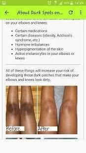 Get Rid Of Dark Knees And Elbows Fast & Naturally screenshot 3