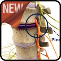 Treating Nerve Pinched on 9Apps