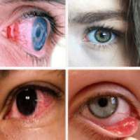 Eye Diseases And Treatments
