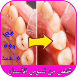 ikon تخلص من تسوس الأسنان في يوم واحد