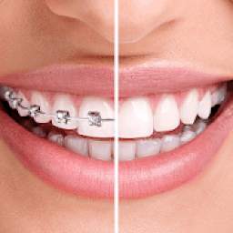 Braces 2018 1.0.0.1