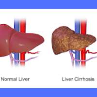 Liver Cirrhosis