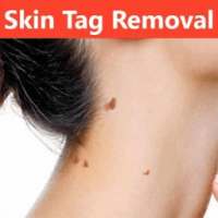 Skin Tag Removal Naturally on 9Apps