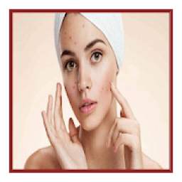 Acne & Pimples (Home Remedies)