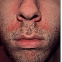 Seborrhea or Seborrheic Dermatitis