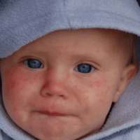 Measles Home Remedies Treatment