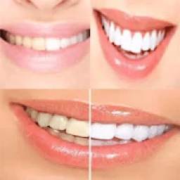 Whitening Teeth Tips