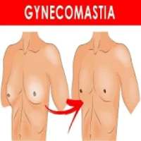 Gynecomastia ( Man Boobs )