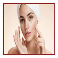 Acne & Pimples (Home Remedies)