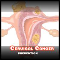 Prevent Cervical Cancer Stay Healthy Cancer traits