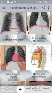 Fundamentals of Chest X-Ray स्क्रीनशॉट 3