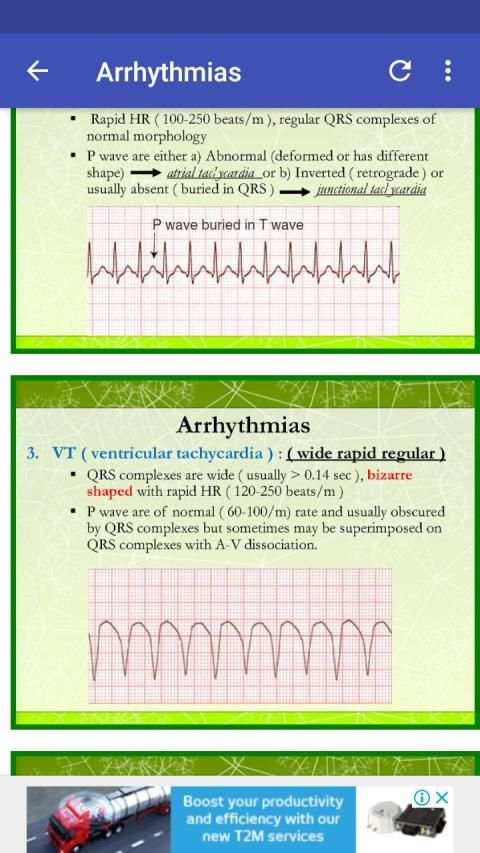 A to Z ECG Interpretation स्क्रीनशॉट 4