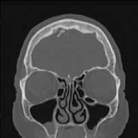 طبقي محوري الجمجمة -ct scan of the skull