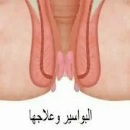 ikon طريقة علاج البواسير في المنزل
‎