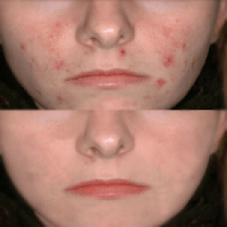 पिम्पल्स हटाने के 120 नुस्खे icon