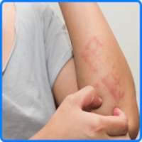 Eczema: Symptoms, Treatment, and Causes