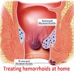 Treating hemorrhoids at home