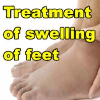 Treatment of swelling of feet