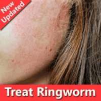 How To Treat Ringworm on 9Apps
