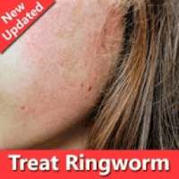 How To Treat Ringworm