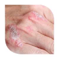 psoriasis treatment on 9Apps